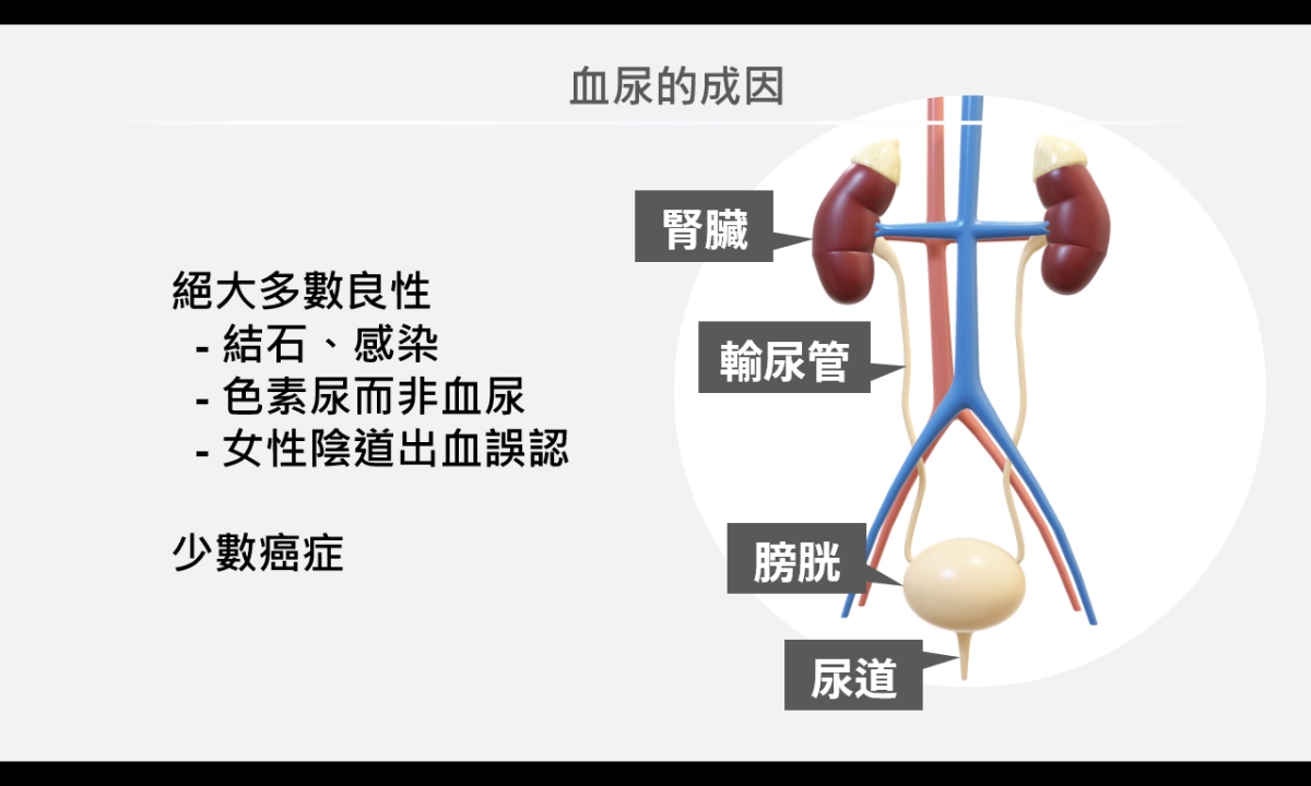 血尿